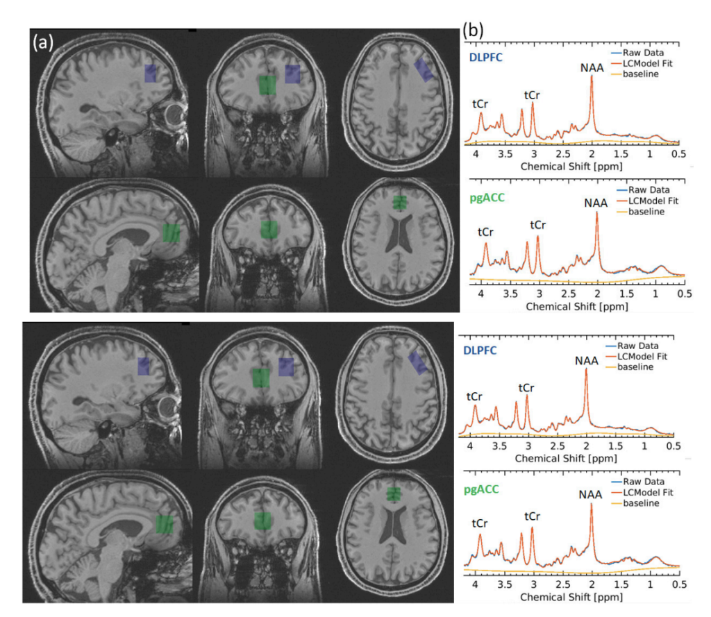 (a) The relative placements of DLPFC (blue) and pgACC (green). (b) The spectra of neurometabolite concentration change (ppm). tCr = total creatine, NAA = N-acetylaspartate.